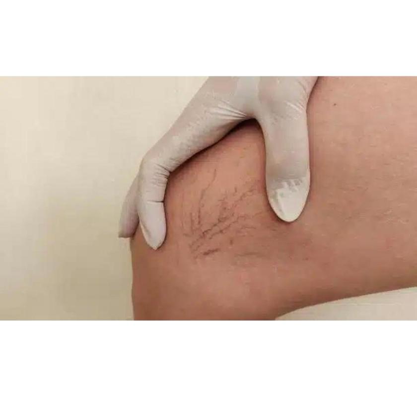 Spider Vein Removal London – Smooth, Clear Skin with Advanced Treatments