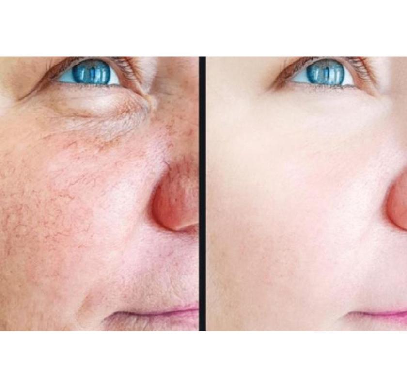 Revitalize Your Skin With Our Non-Invasive Facelift