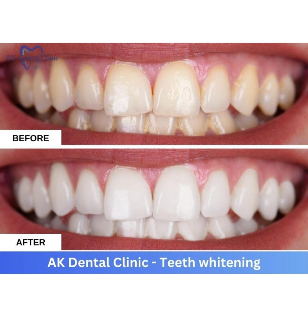 Professional Teeth Whitening in Mumbai Andheri | AK Dental Clinic
