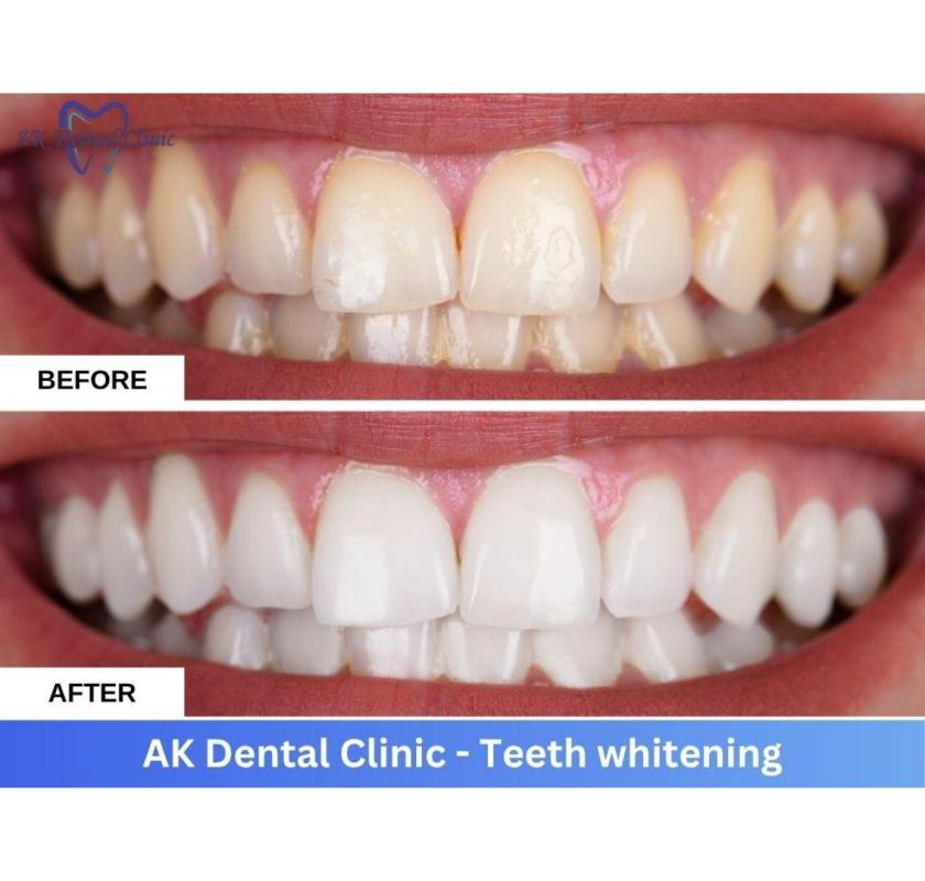 Professional Teeth Whitening in Mumbai Andheri | AK Dental Clinic