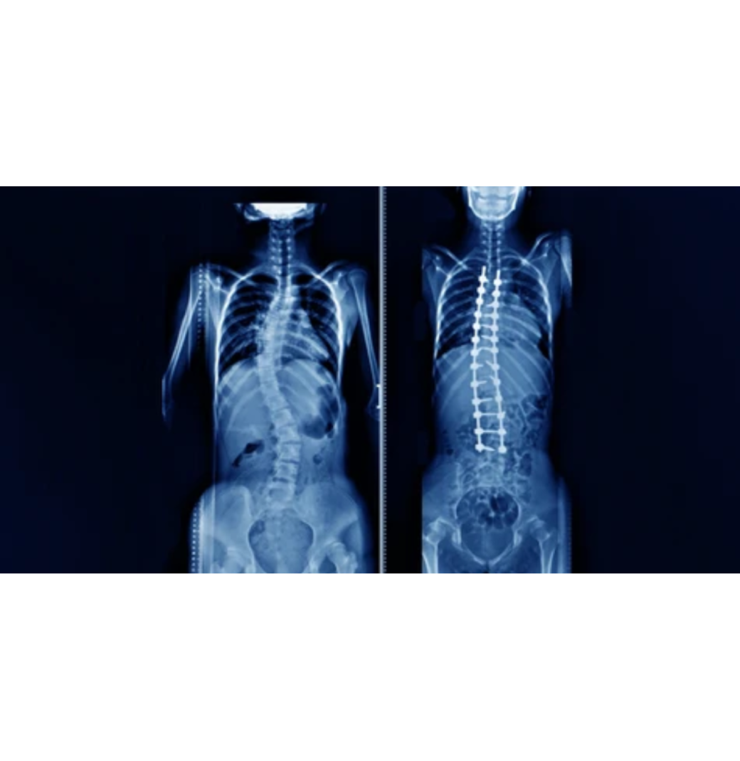 Scoliosis Surgery In Siliguri For Balanced Spine Alignment