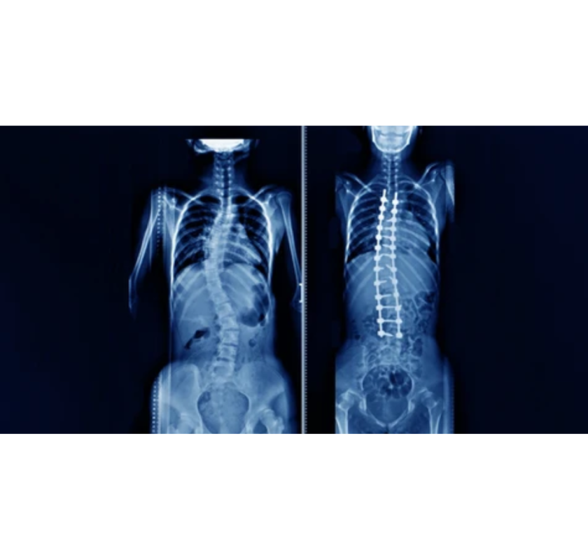 Scoliosis Surgery In Siliguri For Balanced Spine Alignment
