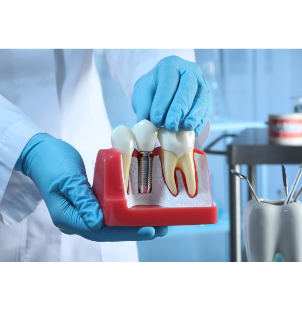 What Are Denture Implants? - 2/3