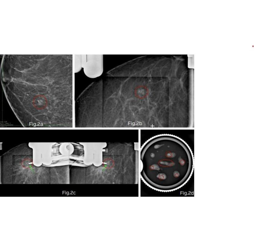 Stereotactic Vacuum Assisted Breast Biopsy in Mumbai – Picture This 