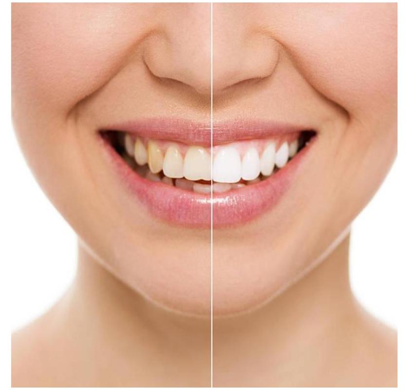 Best Teeth Whitening Melbourne for a Brighter Smile