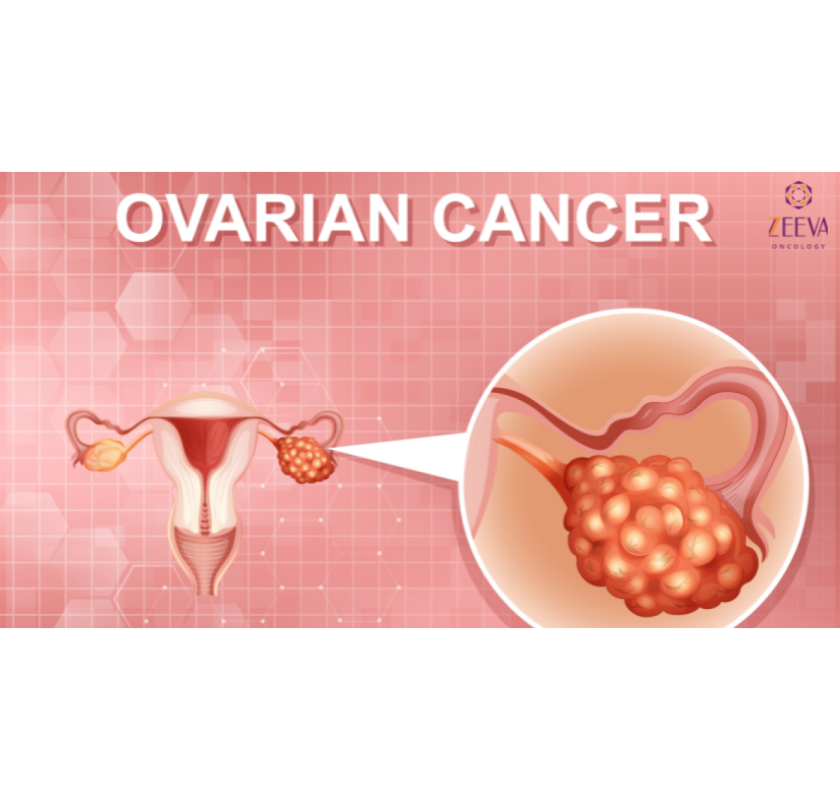 Where Can Women Get Expert Ovarian Cancer Treatment in Noida?