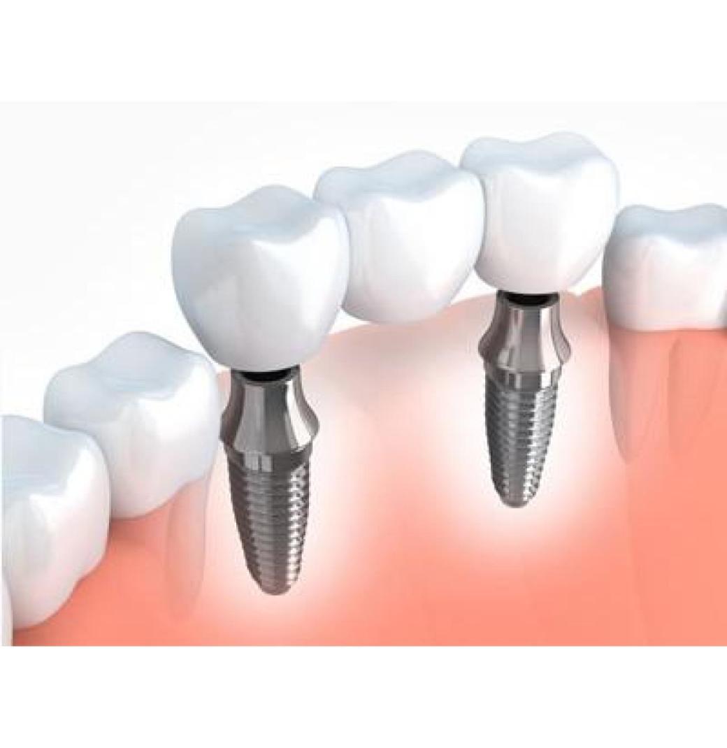 Why Patients Choose Dentures Implants for Full Mouth Restoration? - 2/3