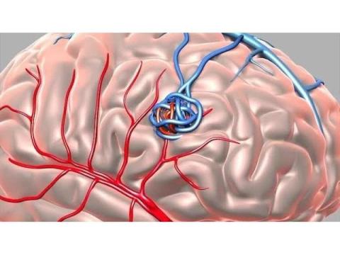 Advanced Care for Colon Arteriovenous Malformation Treatment