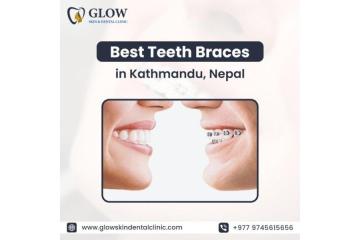 Best Teeth Braces in Kathmandu, Nepal