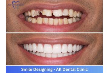 Best Smile Designing Clinic in Vile Parle, Mumbai | AK Dental Clinic