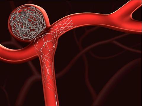Brain Aneurysm Repair Surgery for Safe & Effective Treatment