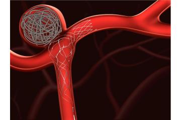 Brain Aneurysm Repair Surgery for Safe & Effective Treatment