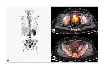 Precision Cancer Detection with Advanced FAPI PET-CT at Picture This Mumbai