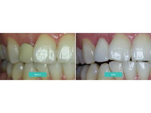 How Teeth Whitening Melbourne Improves Your Smile
