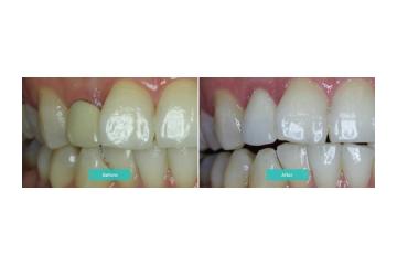 How Teeth Whitening Melbourne Improves Your Smile