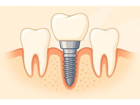 Best Dentures Implants Treatment Center in Portland,OR ! - 2/2