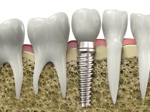 Are denture implants worth it? - 2/2