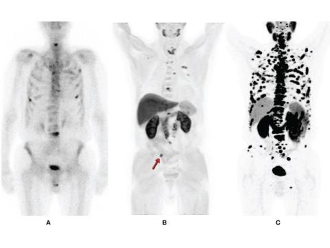 PSMA PET CT Scan for Prostate Cancer Detection - Picture This 