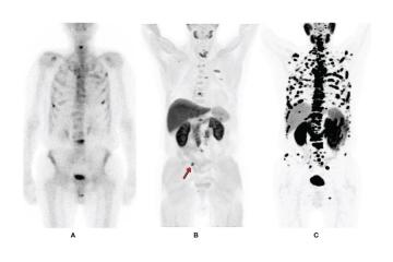 PSMA PET CT Scan for Prostate Cancer Detection - Picture This 