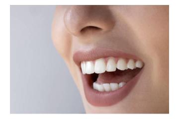 Tooth Color Fillings in Auckland