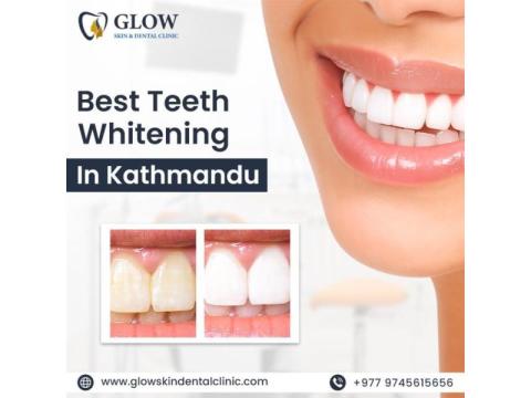 Best Teeth Whitening in Kathmandu