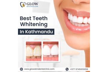 Best Teeth Whitening in Kathmandu