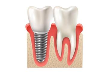 All-on-4 Dental Implants – Full Smile Restoration by Experts