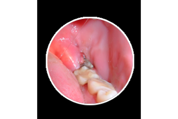 How Wisdom Teeth Infection Removal Helps Pain Fast