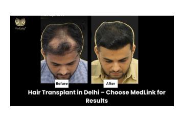 Best Hair Transplant Clinic in Delhi | MedLinks Experts