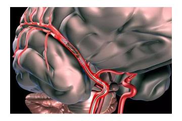 Advanced Stroke Health Center Gandhinagar for Fast Recovery