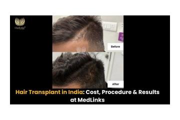 Affordable Hair transplant cost in india by MedLinks -  Consult Now