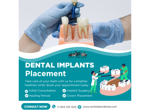 How Safe Is Dental Implants Placement?