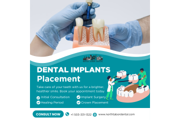 How Safe Is Dental Implants Placement?