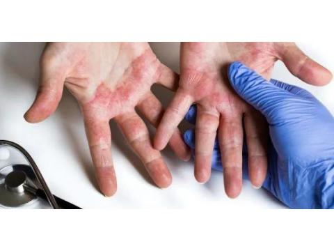 Atopic Dermatitis Treatments in Gurgaon | Expert Care