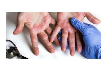 Atopic Dermatitis Treatments in Gurgaon | Expert Care