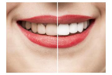Teeth Whitening in Mount Roskill
