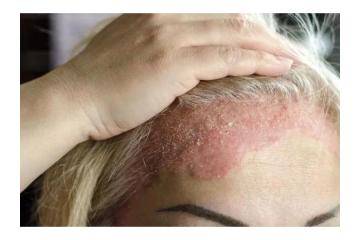 Eczema Rash Treatment in Gurgaon | Skin Experts