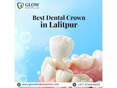 Best Dental Crown in Lalitpur