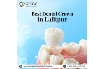 Best Dental Crown in Lalitpur