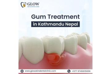 Best Gum treatment in Kathmandu Nepal