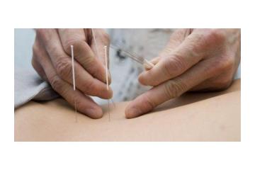 Acupuncture for Weight Control – Natural and Effective Weight Management 