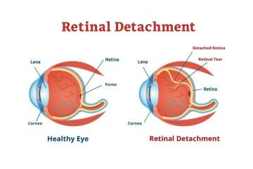 Expert Management of Retinal Detachment & Tears Conditions