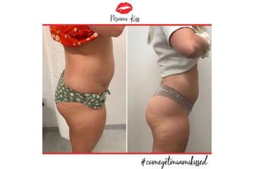 Best Fat Freezing Offers in Varsity Lakes & Nearby Suburbs
