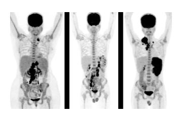 Accurate PET Scan in Mumbai for Cancer Detection – Picture This 