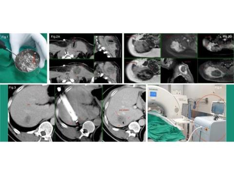 Advanced Cryoablation Therapy for Tumours in Mumbai – Picture This 