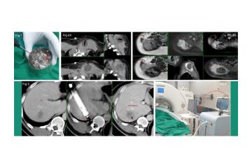 Advanced Cryoablation Therapy for Tumours in Mumbai – Picture This 