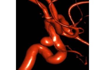 Best Neurosurgeon for Brain Aneurysm Treatment in Surat